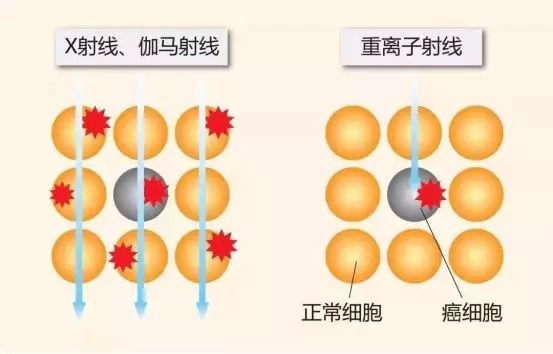 質(zhì)子重離子技術(shù)醫療險可以報銷(xiāo)嗎？